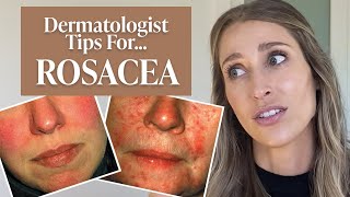 Dermatologist’s Guide to Rosacea What Is It Dos amp Don’ts Treatment Tips amp More  Dr Sam Ellis [upl. by Ahsined]