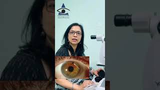 Laser for Glaucoma YAG Iridotomy [upl. by Dej]