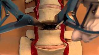 Synthes Spine ProDiscL Lumbar Total Disc Replacement Demonstration Video [upl. by Ynove]