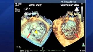 Cleftlike Indentations in Myxomatous Mitral Valves by ThreeDimensional Echocardiographic Imaging [upl. by Baudin834]