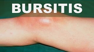 ☞ Remedios caseros para la bursitis – Como aliviar la bursitis en las articulaciones [upl. by Nottnerb]