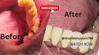 Transformative Smiles lower arch Rehabilitation drabidahussain786 youtube drabidahussain786 ko [upl. by Cordle856]