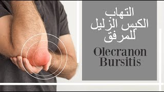 التهاب الجراب الزليل للمرفق كيسة الكوع Elbow Bursitis olecranon bursitis elbow bump subtitled [upl. by Rehm]