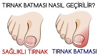 TIRNAK BATMASI NASIL GEÇİRİLİR [upl. by Zindman]