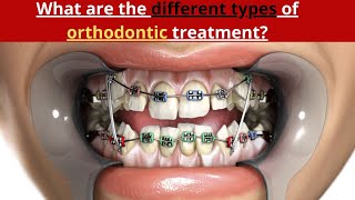 What are the different types of orthodontic treatment [upl. by Holly-Anne643]