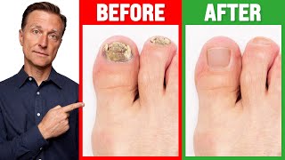 The REAL Cause of Toenail Fungus is [upl. by Ramonda]