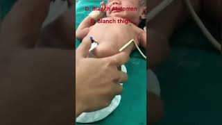 How to check for jaundiceicterus in a newborn [upl. by Meluhs]