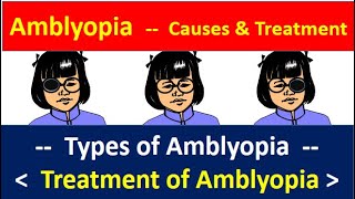 Amblyopia causes and treatment causes types and treatment amblyopia amblyopiatreatment [upl. by Nay]