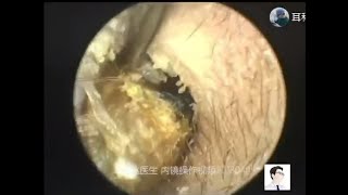 Earwax Removal Extraction Two cases of cholesteatoma by ear endoscopy12min [upl. by Assenav941]