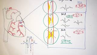 les biomarqueurs cardiaques [upl. by Elizabeth]