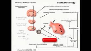 Takotsubo Cardiomyopathy I am Seeing it Everywhere [upl. by Leagiba]