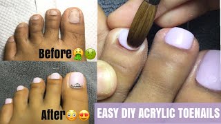 EASY DIY acrylic TOEnails😍TRENDY TOENAILS Quarantine Toenails😍 [upl. by Kieryt]