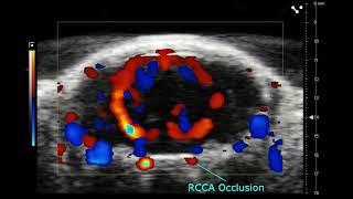 Vasculature in the Brain during Ischemic Stroke [upl. by Pierette775]