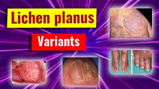 Clinical variants of lichen planus [upl. by Bergess376]