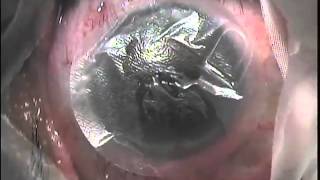 John Hovanesian AmbioLens Amniotic Membrane Transplant Placement with Contact Lens [upl. by Atteynot]