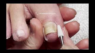 Pedicure Tutorial Toenails that are Squeezing TBT [upl. by Nickolaus410]