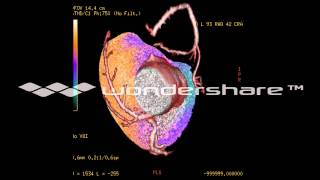 SPECT CT CARDIACO ISQUEMIA SEVERA Y CORONARIA DERECHA OBSTRUIDA [upl. by Alon]