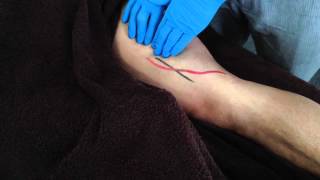 Dry Needling Adductor Magnus [upl. by Esinahs123]