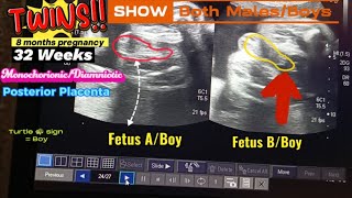 32 Weeks Twins  Boy  Boy  Both Male Fetus  Turtle 🐢 sign  Posterior Placenta  Ultrasound [upl. by Melba]