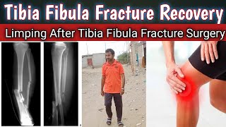 Limping After Tibia Fibula Fracture SurgeryTibia Fibula Fracture RecoveryLimping Kab Tak Thik Huga [upl. by Anaert]