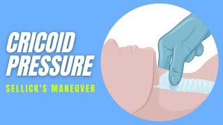 Cricoid pressure  Technique [upl. by Leerzej]