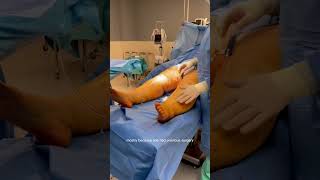 Lipedema Liposuction  Behind the Scene  Dr Boris Volshteyn [upl. by Austine700]