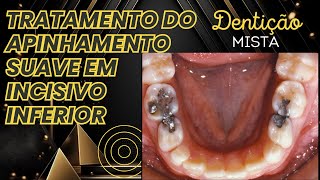 Tratamento de apinhamento suave de incisivos inferiores em dentição mista Aula 155 [upl. by Janus372]