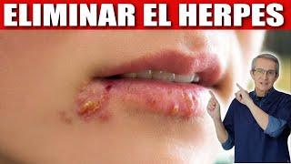 Cómo ELIMINAR el HERPES [upl. by Farkas]