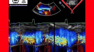 Severe Aortic Regurgitation [upl. by Scrivings]