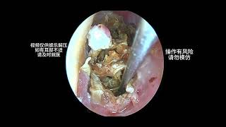 Cleaning a large amount of earwax that severely blocks the ear canal earwaxremoval earwax cleaning [upl. by Leagiba]