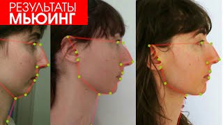 Mewing before and after Mewing по русски Результат до и после [upl. by Nema]