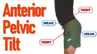 How to fix Anterior Pelvic Tilt APTHindi Simple Exercise at home [upl. by Sitsuj]