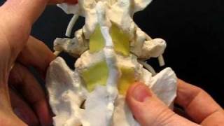 Multilevel Spondylolysis Spondylolisthesis by Dynamic Disc Designs Corp [upl. by Hallimaj]