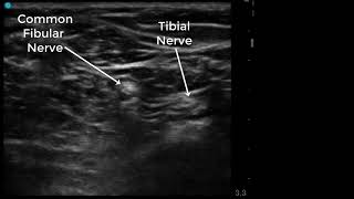 Ultrasound of the Popliteal fossa [upl. by Fihsak309]