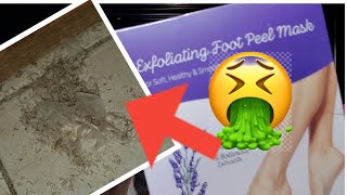 FOOT PEEL TRANSFORMATION [upl. by Ltsyrk687]