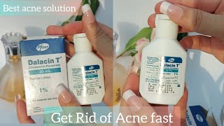 How to get rid of acne fast  Dalacin T lotion Review Clindamycin [upl. by Beghtol485]