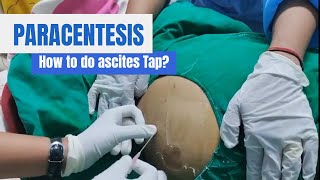 Paracentesis Procedure Ascites Tap in detail [upl. by Alletsyrc]