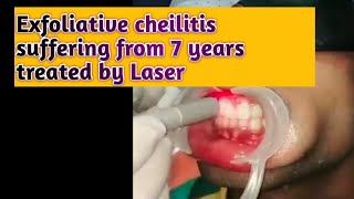 exfoliative cheilitis treatment  exfoliative cheilitis cure  exfoliative cheilitis laser treatment [upl. by Foley]