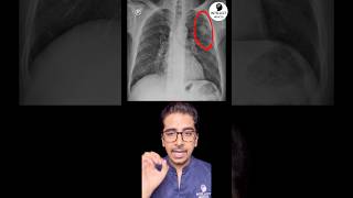 What is shown in Chest Xray pulmonology radiology xray [upl. by Anaeg]