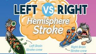 Left vs Right Brain Stroke Key Differences amp Warning Signs [upl. by Elocyn]