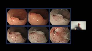 GECHO Fellows Presentation  Assessment of polyps and what to do [upl. by Arrimat]