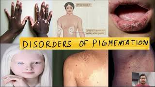 Disorders of pigmentation dermatology essentials essentials vitiligo albinism mole [upl. by Ecnirp]