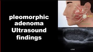 pleomorphic adenoma ultrasound findings [upl. by Danziger]