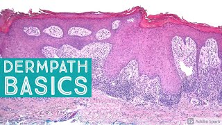 Basic Dermpath Cases  Explained by a Dermatopathologist [upl. by Lewis305]