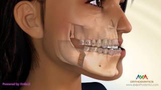 Surgical Orthodontic Treatment for Underbite or Crossbite  BSSO Mandibular Setback [upl. by Zachery]