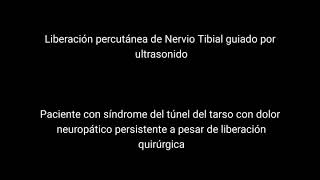 Liberación percutánea de nervio tibial guiado por ultrasonido [upl. by Svirad]