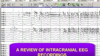 INTRACRANIAL DEPTH ELECTRODE RECORDING [upl. by Alliuqet261]