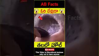 😲తలలో హోల్😲 hole in a mans head telugufacts facts factsintelugu shorts youtubeshorts abfacts [upl. by Adnorehs]