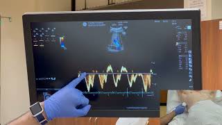 How to perform VExUS scan Venous Excess Ultrasound I Dr Koratala I POCUS [upl. by Ginny]