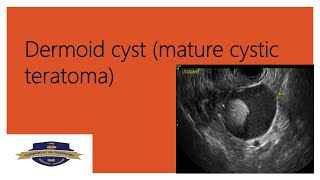 dermoid cyst [upl. by Malkah909]